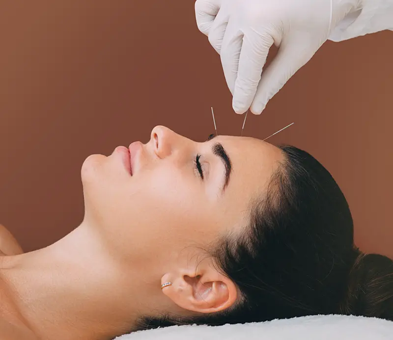 agopuntura cranio per alleviare emicrania