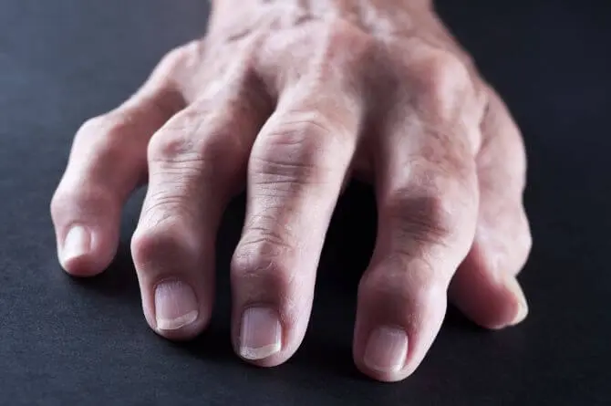 mano affetta da artrite reumatoide