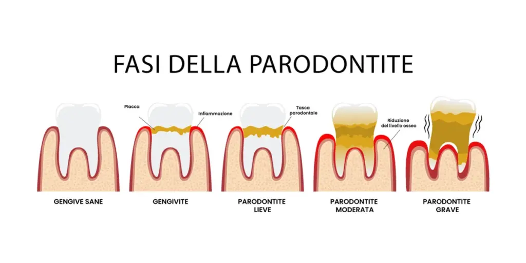 fasi della parodontite illustrazione