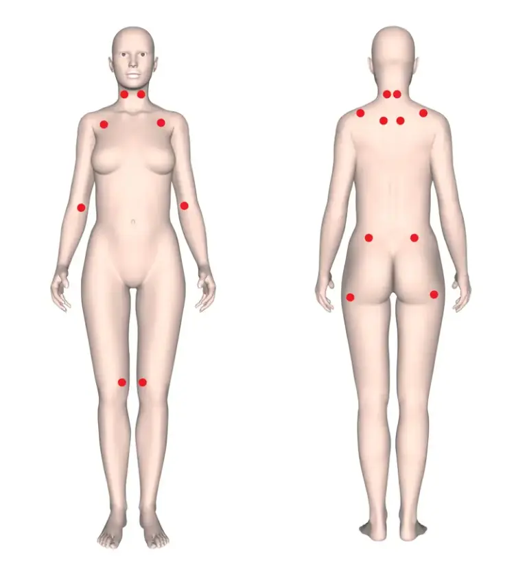 punti dolorosi e punti sensibili della fibromialgia
